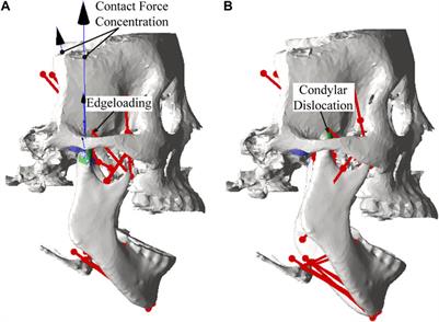 Designing customized temporomandibular fossa prosthesis based on envelope surface of condyle movement: validation via in silico musculoskeletal simulation